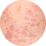 Picture of Roseola Sixth Disease Rash_Small