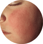 Picture of Slap Cheek Fifth Disease Rash_Small